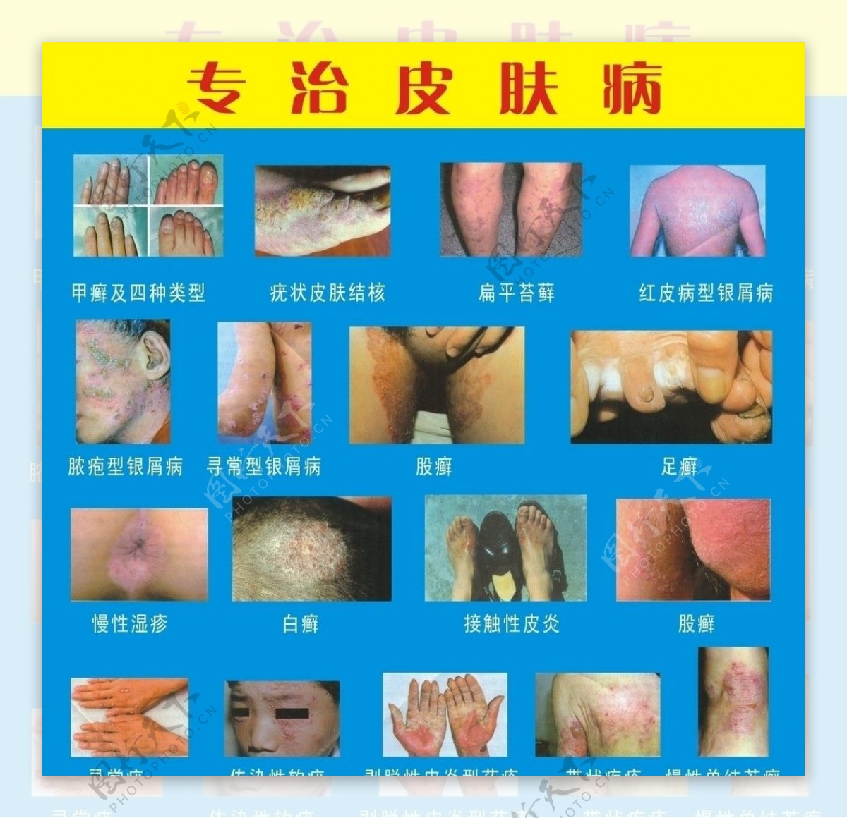 皮肤病图片