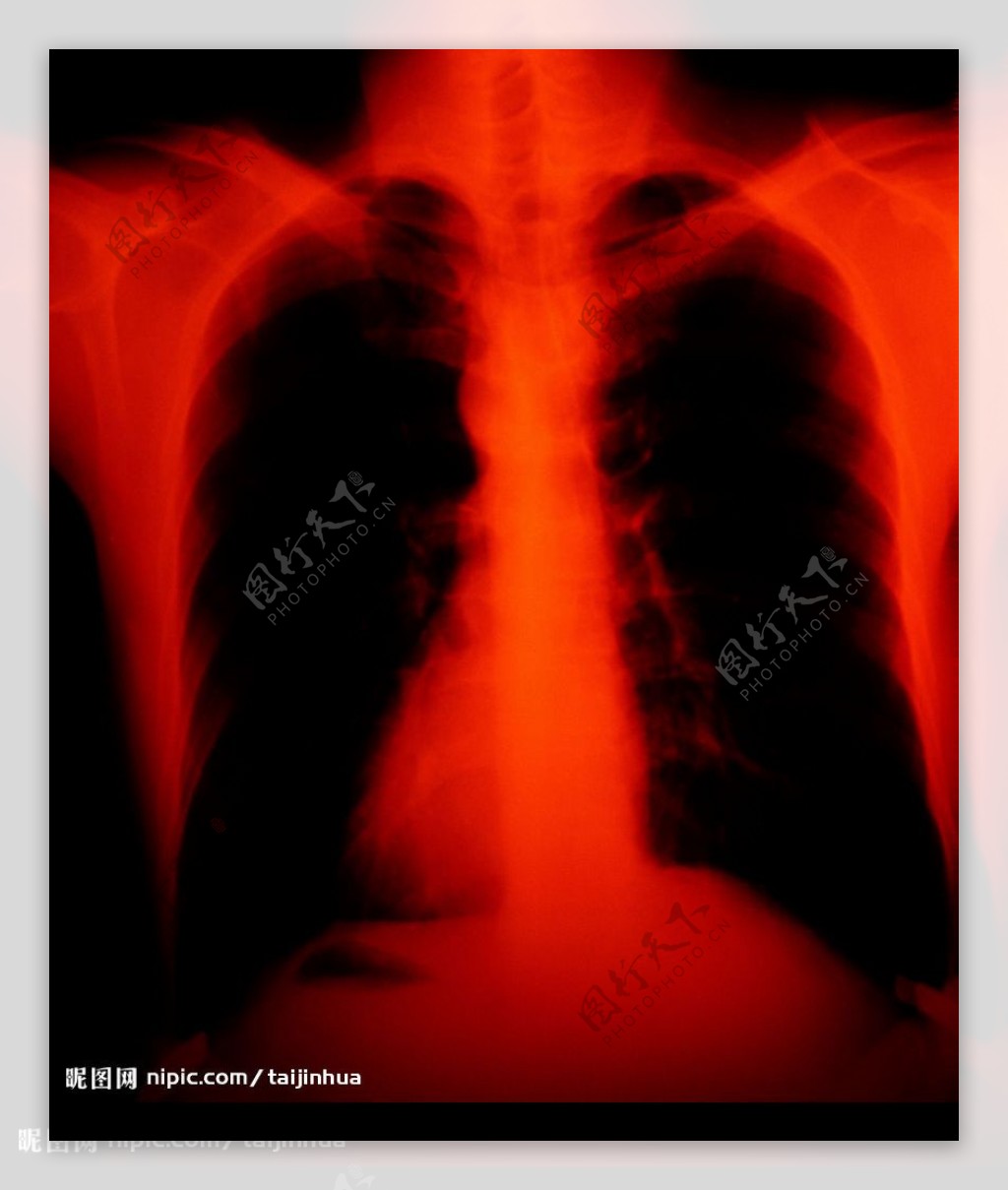 胸腔X光图片