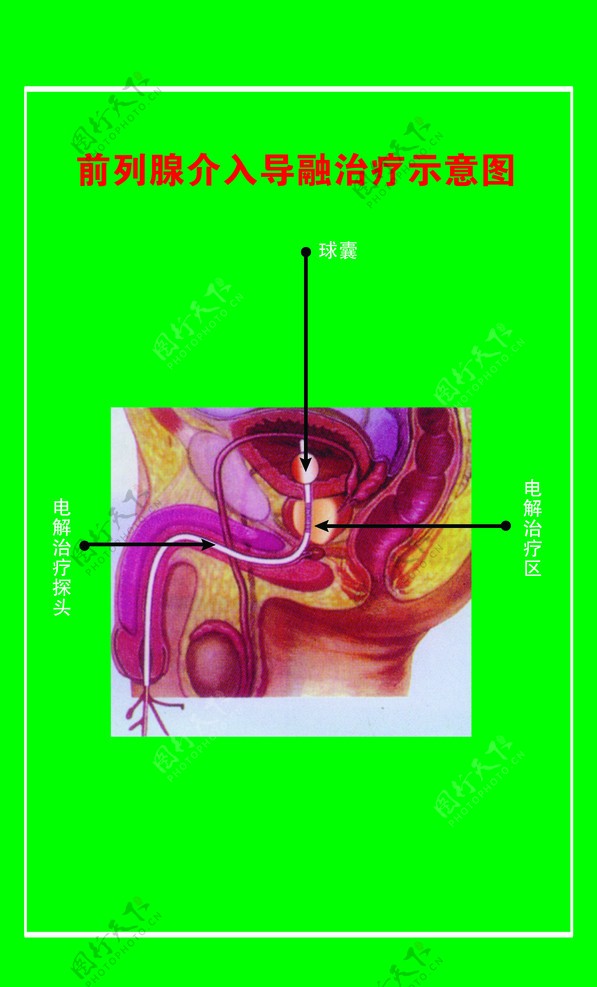 前列腺介入导融治疗示意图图片