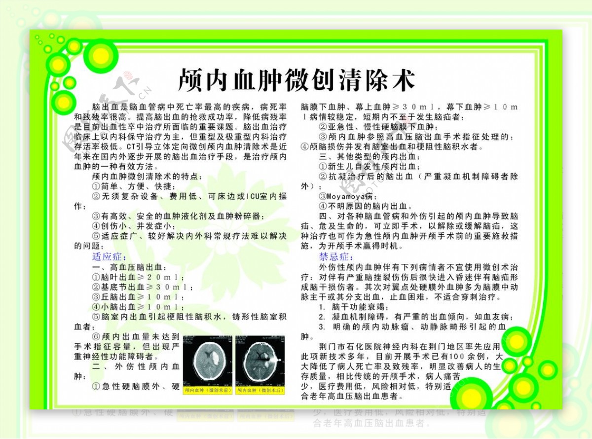 颅内血肿微创清除术图片