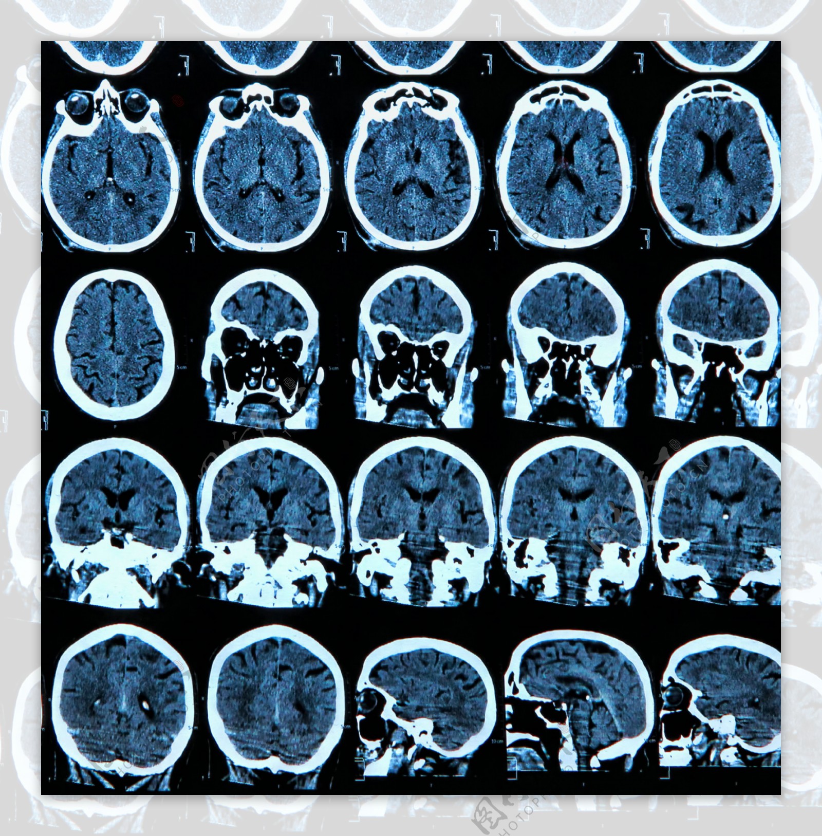 脑部X光片图图片